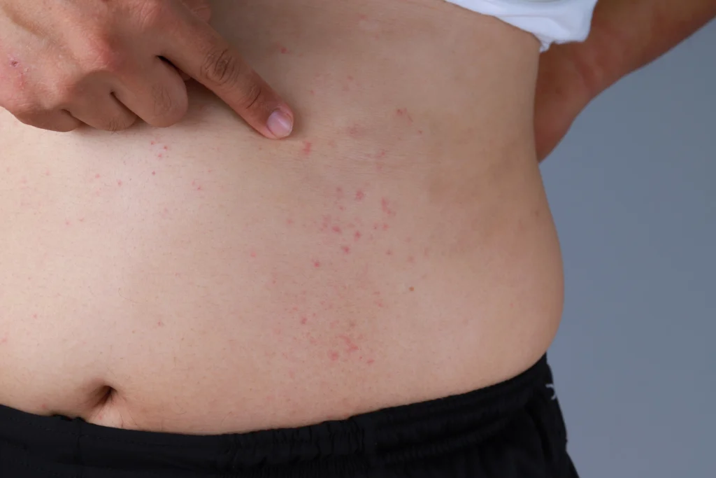 What is Shingles?